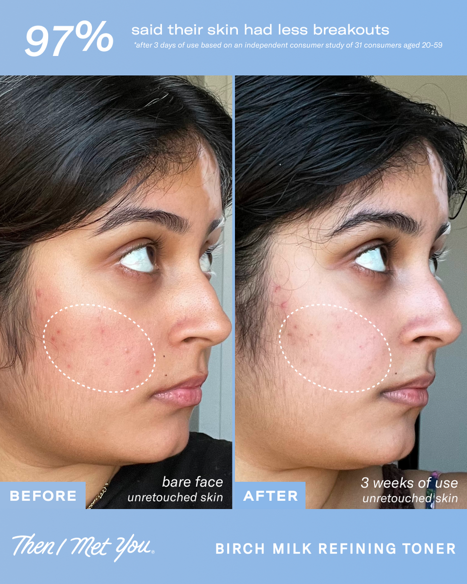 Side-by-side close-up of a woman's cheek before and after using toner, showing smoother skin with less redness and fewer.