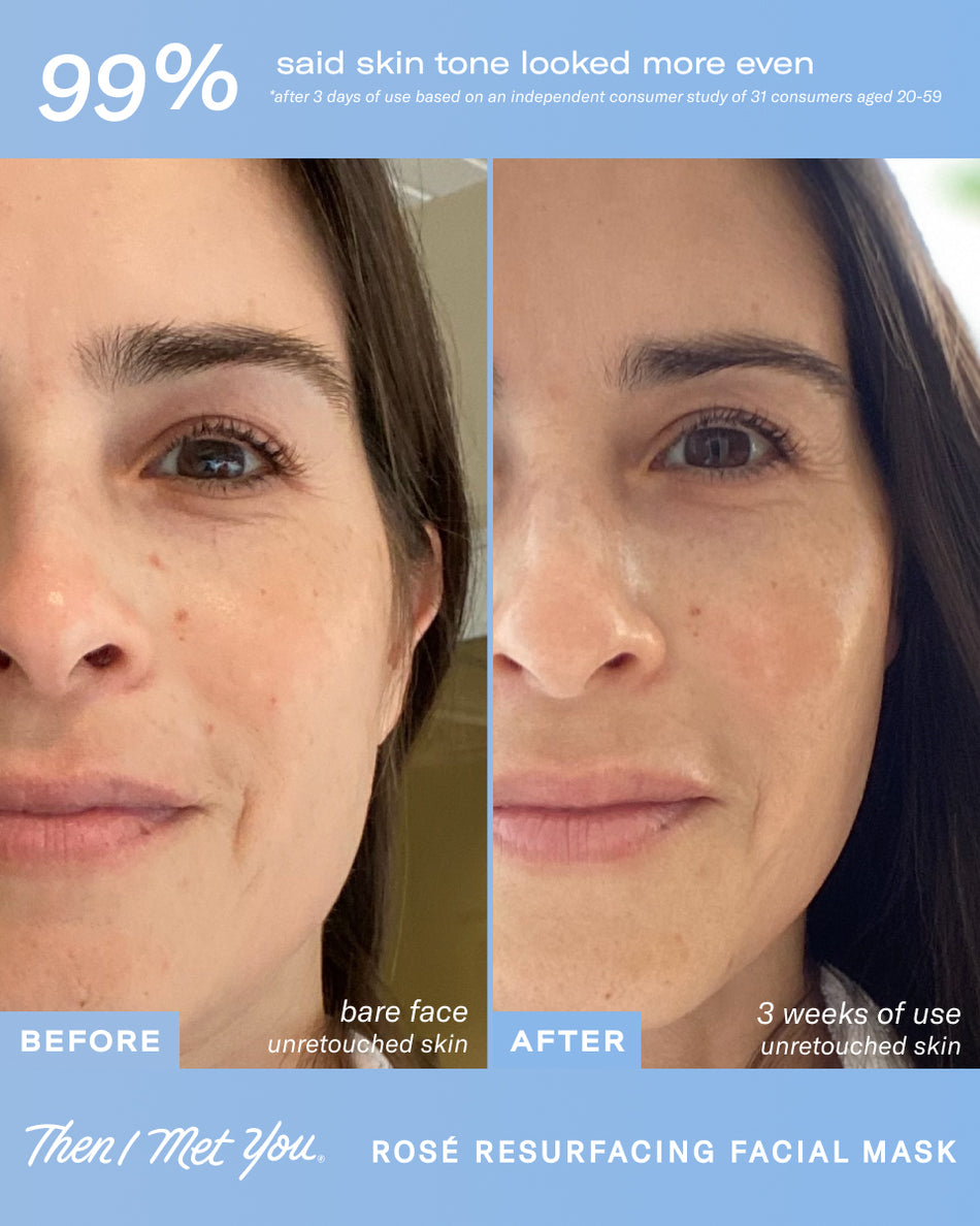 Side-by-side close-up of woman's face before and after using Rosé Resurfacing Facial Mask showing smoother, more even skin.