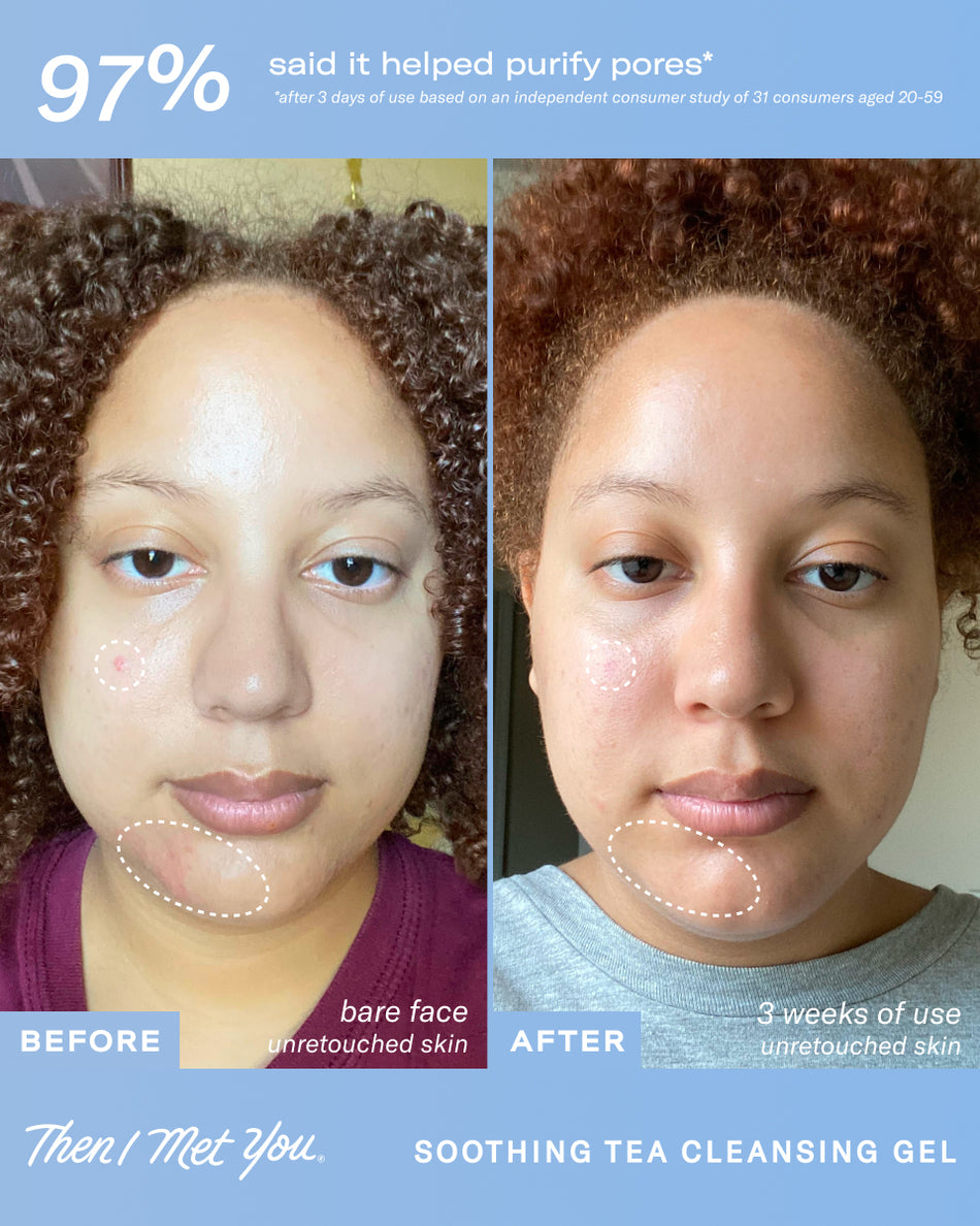 Before and after close-up of woman’s face showing clearer skin after two weeks using Soothing Tea Cleansing Gel.